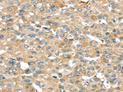 The image on the left is immunohistochemistry of paraffin-embedded Human liver cancer tissue using CSB-PA228089(SRP54 Antibody) at dilution 1/45, on the right is treated with fusion protein. (Original magnification: ×200)