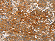 The image on the left is immunohistochemistry of paraffin-embedded Human gastic cancer tissue using CSB-PA228236(CLDN11 Antibody) at dilution 1/25, on the right is treated with synthetic peptide. (Original magnification: ×200)