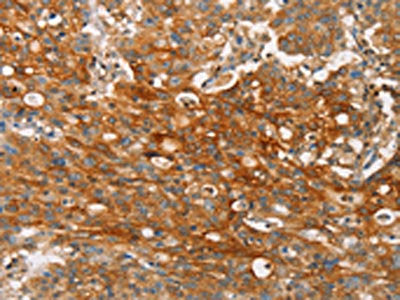 The image on the left is immunohistochemistry of paraffin-embedded Human gastic cancer tissue using CSB-PA228236(CLDN11 Antibody) at dilution 1/25, on the right is treated with synthetic peptide. (Original magnification: ×200)