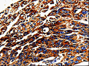 The image on the left is immunohistochemistry of paraffin-embedded Human lung cancer tissue using CSB-PA228295(ALPL Antibody) at dilution 1/25, on the right is treated with fusion protein. (Original magnification: ×200)