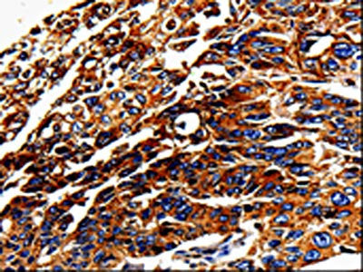 The image on the left is immunohistochemistry of paraffin-embedded Human lung cancer tissue using CSB-PA228295(ALPL Antibody) at dilution 1/25, on the right is treated with fusion protein. (Original magnification: ×200)