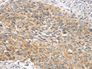 The image on the left is immunohistochemistry of paraffin-embedded Human esophagus cancer tissue using CSB-PA228353(SNX4 Antibody) at dilution 1/25, on the right is treated with fusion protein. (Original magnification: ×200)