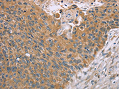 The image on the left is immunohistochemistry of paraffin-embedded Human esophagus cancer tissue using CSB-PA228555(SAMD4B Antibody) at dilution 1/40, on the right is treated with synthetic peptide. (Original magnification: ×200)