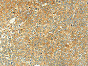 The image on the left is immunohistochemistry of paraffin-embedded Human ovarian cancer tissue using CSB-PA228573(TGM5 Antibody) at dilution 1/25, on the right is treated with synthetic peptide. (Original magnification: ×200)