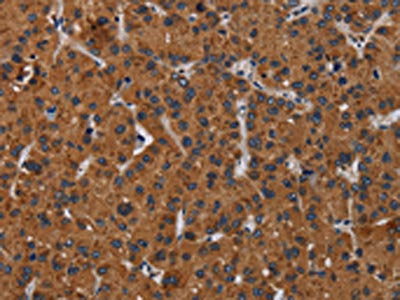 The image on the left is immunohistochemistry of paraffin-embedded Human liver cancer tissue using CSB-PA228825(KLK8 Antibody) at dilution 1/50, on the right is treated with fusion protein. (Original magnification: ×200)