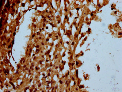 IHC image of CSB-PA22889A0Rb diluted at 1:100 and staining in paraffin-embedded human melanoma performed on a Leica BondTM system. After dewaxing and hydration, antigen retrieval was mediated by high pressure in a citrate buffer (pH 6.0). Section...