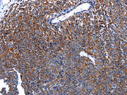 The image on the left is immunohistochemistry of paraffin-embedded Human ovarian cancer tissue using CSB-PA228918(HSPD1 Antibody) at dilution 1/30, on the right is treated with fusion protein. (Original magnification: ×200)