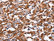 The image on the left is immunohistochemistry of paraffin-embedded Human thyroid cancer tissue using CSB-PA229005(KCNJ9 Antibody) at dilution 1/15, on the right is treated with synthetic peptide. (Original magnification: ×200)