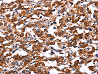 The image on the left is immunohistochemistry of paraffin-embedded Human thyroid cancer tissue using CSB-PA229005(KCNJ9 Antibody) at dilution 1/15, on the right is treated with synthetic peptide. (Original magnification: ×200)
