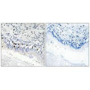 Immunohistochemistry analysis of paraffin-embedded human lung carcinoma tissue, using MED12 antibody.