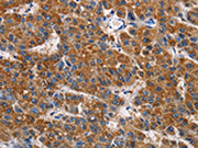 The image on the left is immunohistochemistry of paraffin-embedded Human liver cancer tissue using CSB-PA229044(APLNR Antibody) at dilution 1/50, on the right is treated with fusion protein. (Original magnification: ×200)