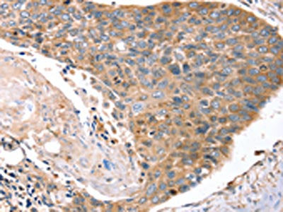 The image on the left is immunohistochemistry of paraffin-embedded Human esophagus cancer tissue using CSB-PA229173(LAMP3 Antibody) at dilution 1/20, on the right is treated with synthetic peptide. (Original magnification: ×200)