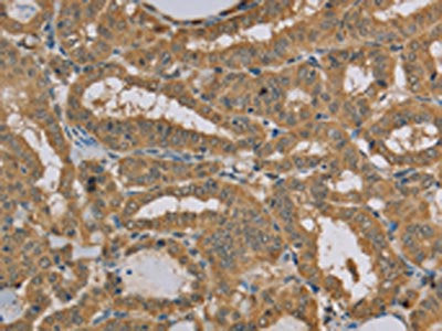 The image on the left is immunohistochemistry of paraffin-embedded Human thyroid cancer tissue using CSB-PA229254(MVK Antibody) at dilution 1/20, on the right is treated with fusion protein. (Original magnification: ×200)