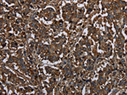 The image on the left is immunohistochemistry of paraffin-embedded Human liver cancer tissue using CSB-PA229264(HACL1 Antibody) at dilution 1/20, on the right is treated with fusion protein. (Original magnification: ×200)