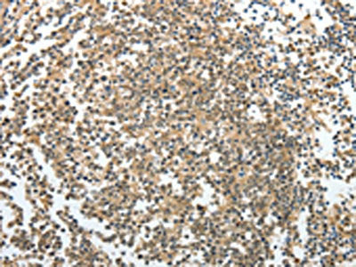 The image on the left is immunohistochemistry of paraffin-embedded Human tonsil tissue using CSB-PA229403(PRMT2 Antibody) at dilution 1/30, on the right is treated with fusion protein. (Original magnification: ×200)