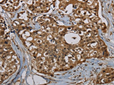 The image on the left is immunohistochemistry of paraffin-embedded Human breast cancer tissue using CSB-PA229404(PNN Antibody) at dilution 1/50, on the right is treated with synthetic peptide. (Original magnification: ×200)