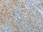 The image on the left is immunohistochemistry of paraffin-embedded Human liver cancer tissue using CSB-PA229503(TNFRSF1B Antibody) at dilution 1/5, on the right is treated with fusion protein. (Original magnification: ×200)