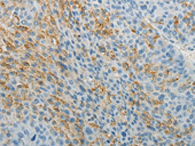 The image on the left is immunohistochemistry of paraffin-embedded Human liver cancer tissue using CSB-PA229503(TNFRSF1B Antibody) at dilution 1/5, on the right is treated with fusion protein. (Original magnification: ×200)
