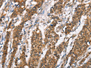 The image on the left is immunohistochemistry of paraffin-embedded Human gastic cancer tissue using CSB-PA229519(DSC2 Antibody) at dilution 1/25, on the right is treated with synthetic peptide. (Original magnification: ×200)