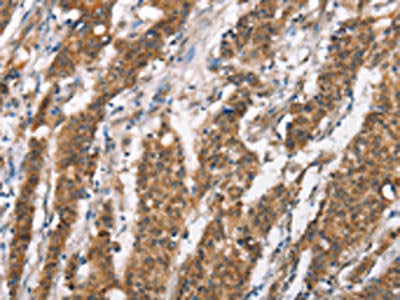 The image on the left is immunohistochemistry of paraffin-embedded Human gastic cancer tissue using CSB-PA229519(DSC2 Antibody) at dilution 1/25, on the right is treated with synthetic peptide. (Original magnification: ×200)