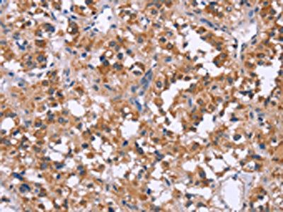The image on the left is immunohistochemistry of paraffin-embedded Human thyroid cancer tissue using CSB-PA229662(APAF1 Antibody) at dilution 1/20, on the right is treated with synthetic peptide. (Original magnification: ×200)