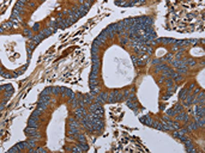 The image on the left is immunohistochemistry of paraffin-embedded Human colon cancer tissue using CSB-PA229750(MT-ND6 Antibody) at dilution 1/40, on the right is treated with synthetic peptide. (Original magnification: ×200)