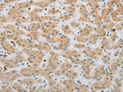 The image on the left is immunohistochemistry of paraffin-embedded Human liver cancer tissue using CSB-PA229808(NBN Antibody) at dilution 1/50, on the right is treated with synthetic peptide. (Original magnification: ×200)