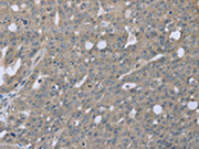 The image on the left is immunohistochemistry of paraffin-embedded Human ovarian cancer tissue using CSB-PA229873(BMX Antibody) at dilution 1/30, on the right is treated with fusion protein. (Original magnification: ×200)
