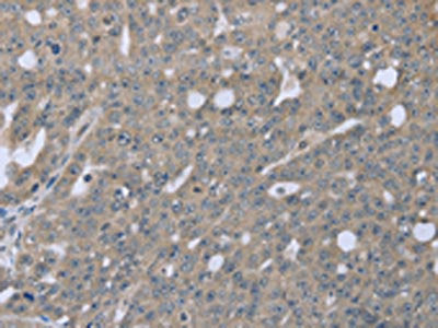 The image on the left is immunohistochemistry of paraffin-embedded Human ovarian cancer tissue using CSB-PA229873(BMX Antibody) at dilution 1/30, on the right is treated with fusion protein. (Original magnification: ×200)