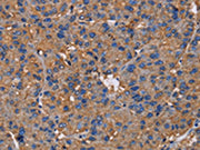 The image on the left is immunohistochemistry of paraffin-embedded Human liver cancer tissue using CSB-PA229917(NCSTN Antibody) at dilution 1/50, on the right is treated with fusion protein. (Original magnification: ×200)