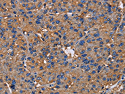 The image on the left is immunohistochemistry of paraffin-embedded Human liver cancer tissue using CSB-PA229917(NCSTN Antibody) at dilution 1/50, on the right is treated with fusion protein. (Original magnification: ×200)