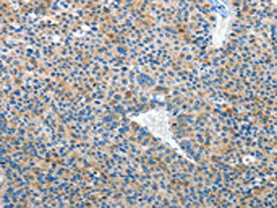 The image on the left is immunohistochemistry of paraffin-embedded Human liver cancer tissue using CSB-PA229924(EPHB3 Antibody) at dilution 1/50, on the right is treated with synthetic peptide. (Original magnification: ×200)