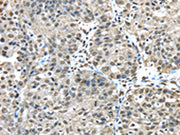 The image on the left is immunohistochemistry of paraffin-embedded Human breast cancer tissue using CSB-PA229936(FUS Antibody) at dilution 1/45, on the right is treated with fusion protein. (Original magnification: ×200)