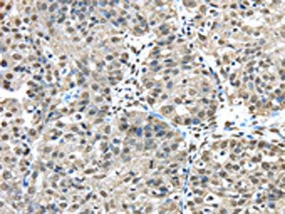 The image on the left is immunohistochemistry of paraffin-embedded Human breast cancer tissue using CSB-PA229936(FUS Antibody) at dilution 1/45, on the right is treated with fusion protein. (Original magnification: ×200)