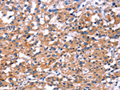 The image on the left is immunohistochemistry of paraffin-embedded Human thyroid cancer tissue using CSB-PA230288(IRS1 Antibody) at dilution 1/30, on the right is treated with fusion protein. (Original magnification: ×200)