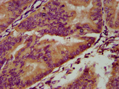 IHC image of CSB-PA23039A0Rb diluted at 1:200 and staining in paraffin-embedded human endometrial cancer performed on a Leica BondTM system. After dewaxing and hydration, antigen retrieval was mediated by high pressure in a citrate buffer (pH 6.0)...