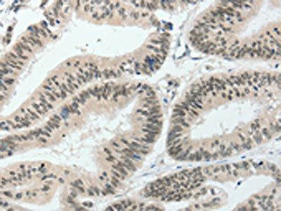 The image on the left is immunohistochemistry of paraffin-embedded Human colon cancer tissue using CSB-PA230499(HNF1B Antibody) at dilution 1/80, on the right is treated with synthetic peptide. (Original magnification: ×200)