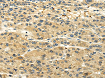 The image on the left is immunohistochemistry of paraffin-embedded Human liver cancer tissue using CSB-PA230502(UGT1A6 Antibody) at dilution 1/20, on the right is treated with synthetic peptide. (Original magnification: ×200)