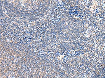 The image on the left is immunohistochemistry of paraffin-embedded Human tonsil tissue using CSB-PA230617(GRB14 Antibody) at dilution 1/20, on the right is treated with fusion protein. (Original magnification: ×200)