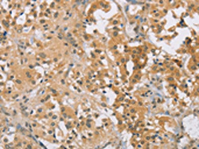 The image on the left is immunohistochemistry of paraffin-embedded Human thyroid cancer tissue using CSB-PA230952(CENPF Antibody) at dilution 1/30, on the right is treated with synthetic peptide. (Original magnification: ×200)