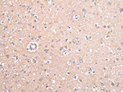 The image on the left is immunohistochemistry of paraffin-embedded Human brain tissue using CSB-PA231151(GJB5 Antibody) at dilution 1/45, on the right is treated with synthetic peptide. (Original magnification: ×200)