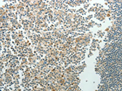 The image on the left is immunohistochemistry of paraffin-embedded Human tonsil tissue using CSB-PA231152(NDRG3 Antibody) at dilution 1/70, on the right is treated with synthetic peptide. (Original magnification: ×200)