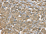 The image on the left is immunohistochemistry of paraffin-embedded Human breast cancer tissue using CSB-PA231185(SERPINA11 Antibody) at dilution 1/35, on the right is treated with synthetic peptide. (Original magnification: ×200)
