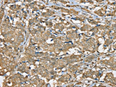 The image on the left is immunohistochemistry of paraffin-embedded Human breast cancer tissue using CSB-PA231185(SERPINA11 Antibody) at dilution 1/35, on the right is treated with synthetic peptide. (Original magnification: ×200)