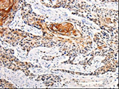 The image is immunohistochemistry of paraffin-embedded Human esophagus cancer tissue using CSB-PA231310(ANGPTL4 Antibody) at dilution 1/25. (Original magnification: 200)