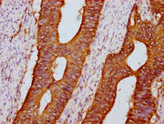 IHC image of CSB-PA23149A0Rb diluted at 1:600 and staining in paraffin-embedded human colon cancer performed on a Leica BondTM system. After dewaxing and hydration, antigen retrieval was mediated by high pressure in a citrate buffer (pH 6.0). Sect...