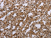 The image on the left is immunohistochemistry of paraffin-embedded Human prostate cancer tissue using CSB-PA231550(MEIS1 Antibody) at dilution 1/40, on the right is treated with synthetic peptide. (Original magnification: ×200)