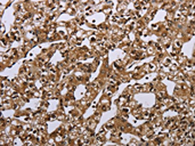 The image on the left is immunohistochemistry of paraffin-embedded Human prostate cancer tissue using CSB-PA231550(MEIS1 Antibody) at dilution 1/40, on the right is treated with synthetic peptide. (Original magnification: ×200)