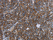 The image on the left is immunohistochemistry of paraffin-embedded Human ovarian cancer tissue using CSB-PA231615(NDUFA13 Antibody) at dilution 1/40, on the right is treated with fusion protein. (Original magnification: ×200)