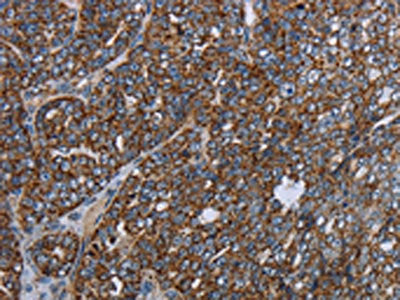The image on the left is immunohistochemistry of paraffin-embedded Human ovarian cancer tissue using CSB-PA231615(NDUFA13 Antibody) at dilution 1/40, on the right is treated with fusion protein. (Original magnification: ×200)